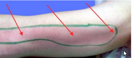 Lymphangitis nach Katzenbiss