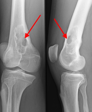 Osteolyse bei Plasmozytom