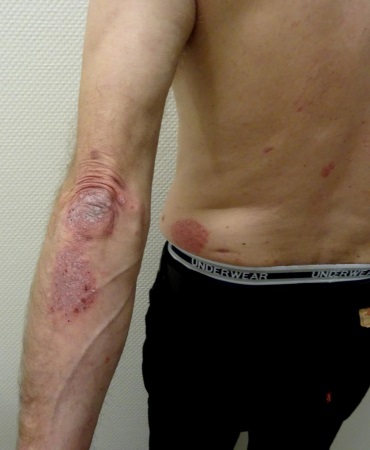 Psoriasis am Ellenbogen