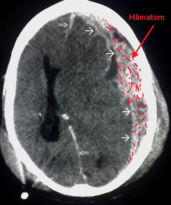 Hämatom intracraniell