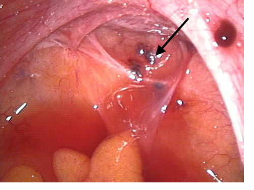 Endometriose im Douglasraum