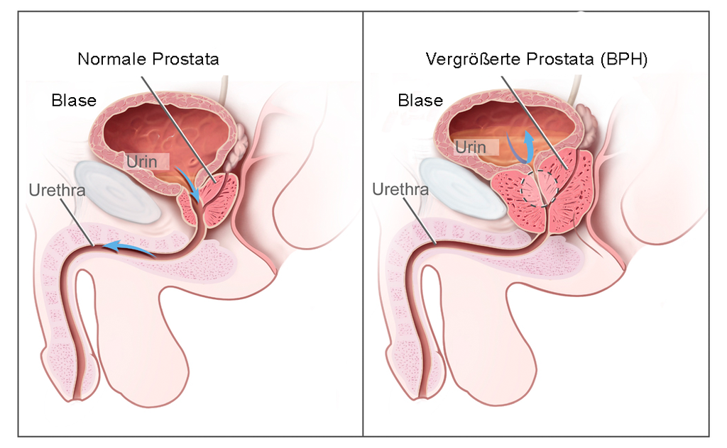 Prostatahyperplasie