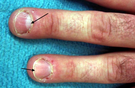 Tüpfelnagel bei Psoriasis