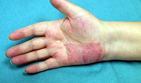 Psoriasis an der Hand