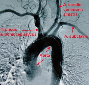 Aortenbogen mit großen Arterien