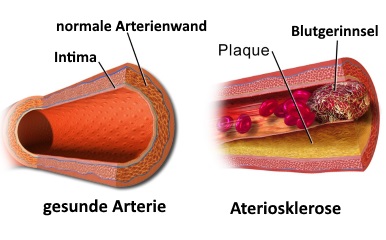 Arterienverschluss