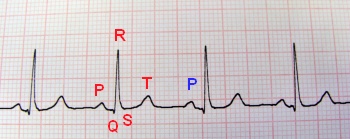 normales EKG 