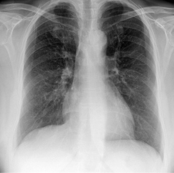 normales Herz bei Röntgen Thorax