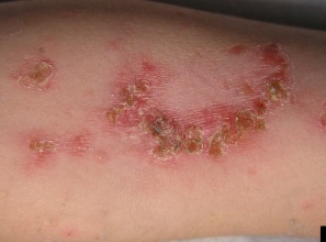 Impetigo honiggelbe Krusten