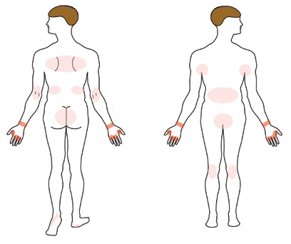 Scabies Befall