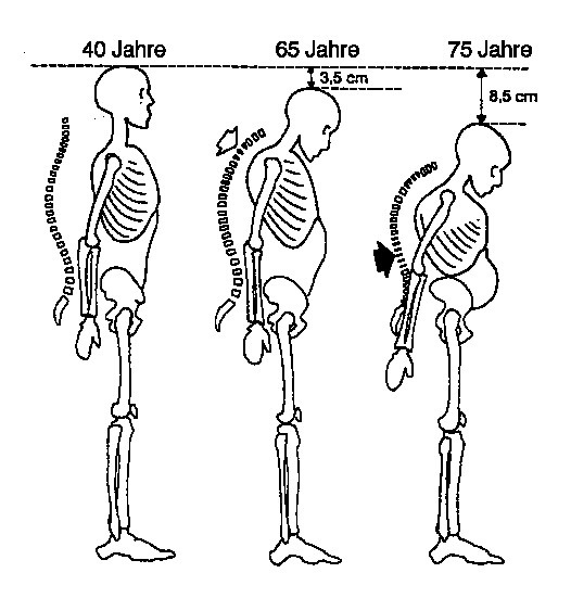 Osteoporose