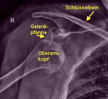 Gelenk-Luxation am Beispiel Schulter