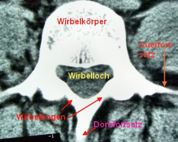 Wirbel mit Wirbelbögen, Dornfortsatz und Querfortsatz