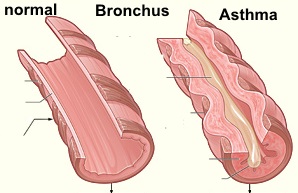 Bronchien bei Asthma