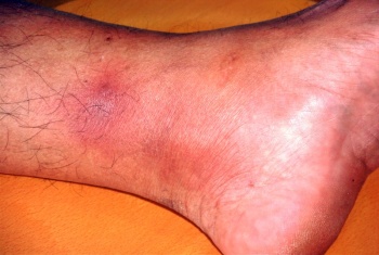 Erythema nodosum bei rheumatischem Fieber