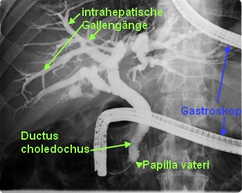 ERCP bei posthepatischem Ikterus