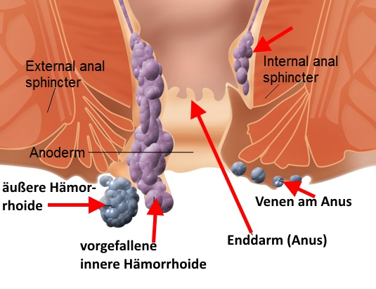 Hämorrhoiden