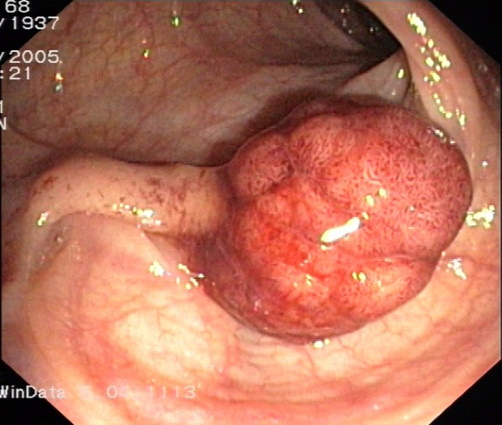 Dickdarmpolyp