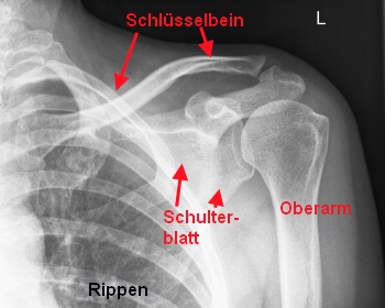 Schultergürtel (Röntgenbild)