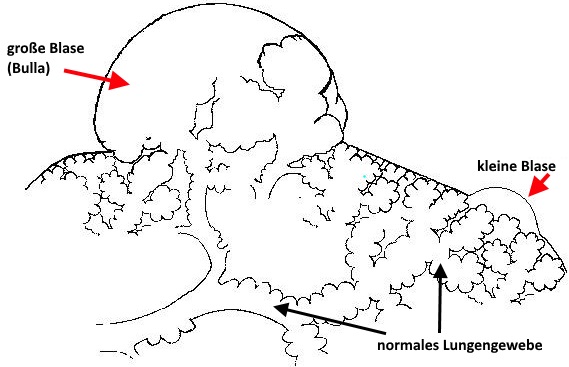 Spontanpneumothorax durch Blase in der Lunge