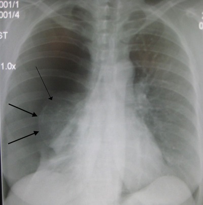 Röntgenbild eines Pneumothorax