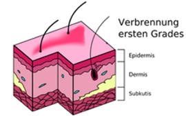 Verbrennung ersten Grades