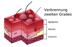 Verbrennung 2. Grades