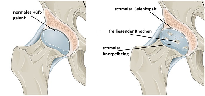 Arthose im Vergleich zum gesunden Gelenk