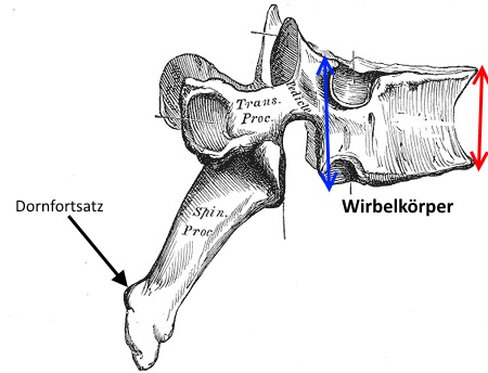Wirbel bei Morbus Scheuermann