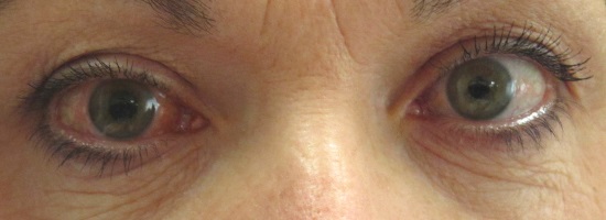 akuter Glaukomanfall am Auge