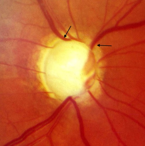 Sehnervenpapille bei einem Glaukom