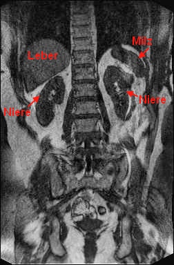 Niere im Kernspintomomgramm (MRT)